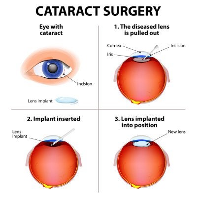 Cataract Surgery In Chicago